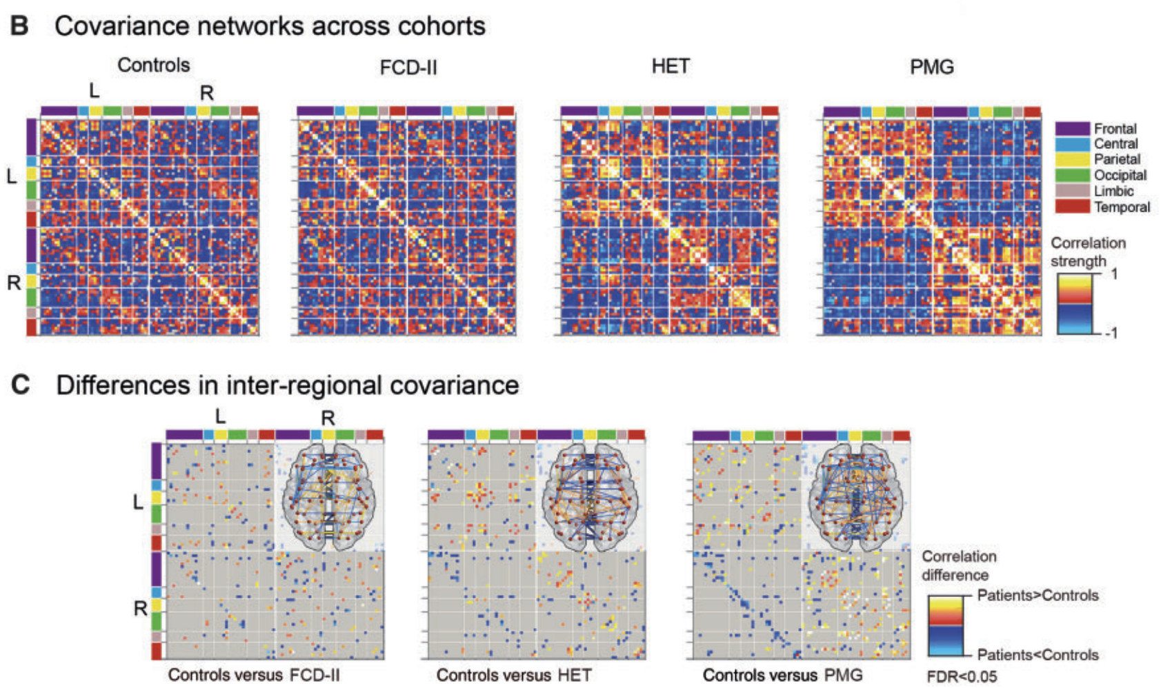 The spectrum of brain network alterations in epileptogenic cortical malformations